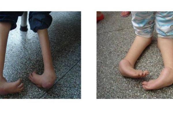 儿童内八字脚